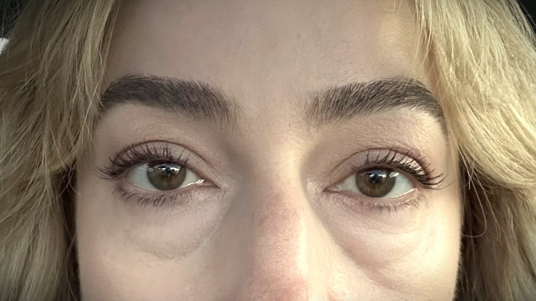 Ilustrasi puffy eyes atau mata bengkak