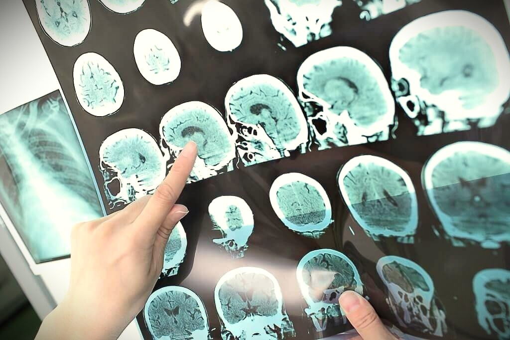 Ilustrasi kanker otak