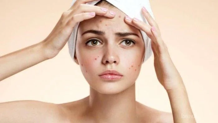 Salah satu penyebab jerawat yang sering diabaikan adalah faktor genetik.