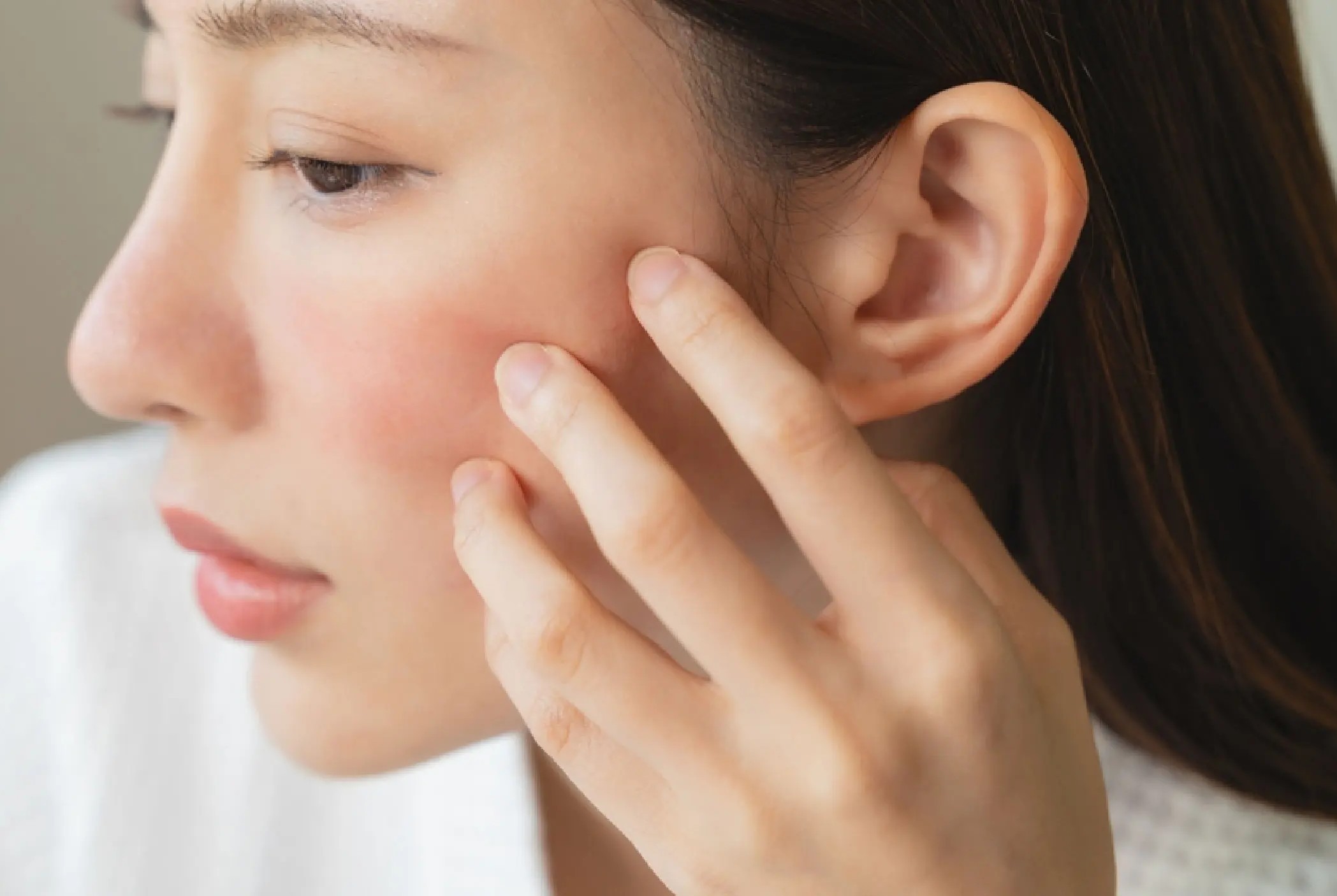 Ilustrasi kulit merah karena jerawat